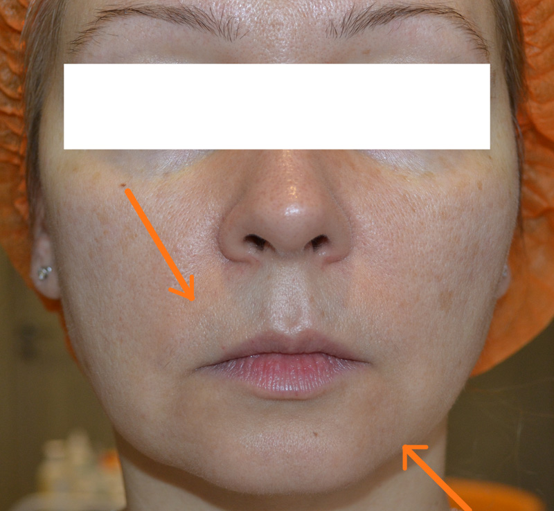 Биоревитализация фото до и после процедуры, Биоревитализация кожи фото